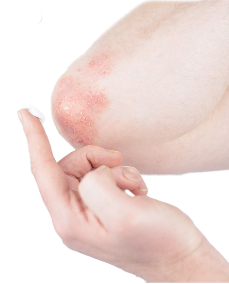 Eczema Knee